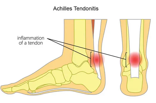 Achilles Diagram