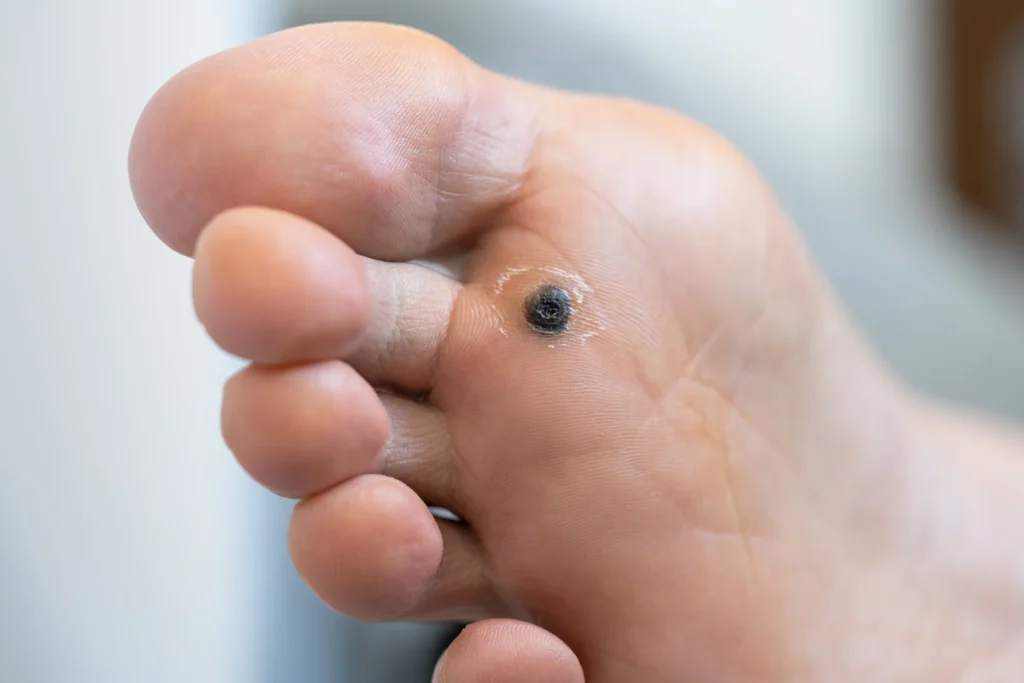 plantar wart on foot close up view 2026 03 19 23 21 19 utc